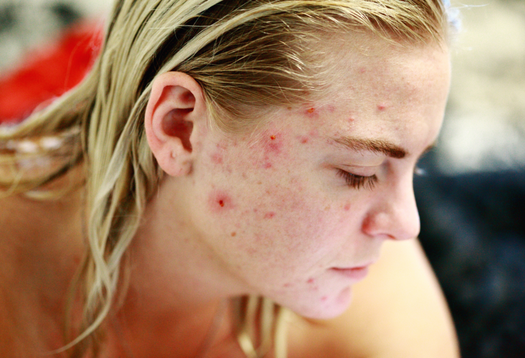 You Won't Believe This Weird Trick to Erase Adult Acne